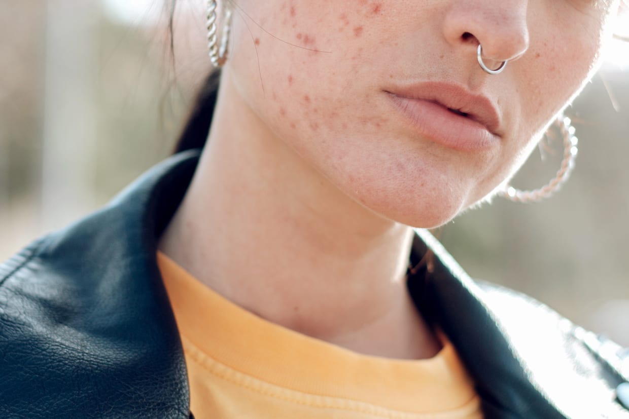 A portrait of a young woman with acne.