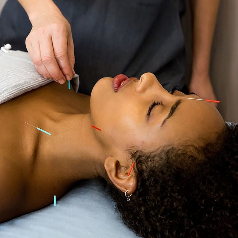 A woman receiving an acupuncture facial.