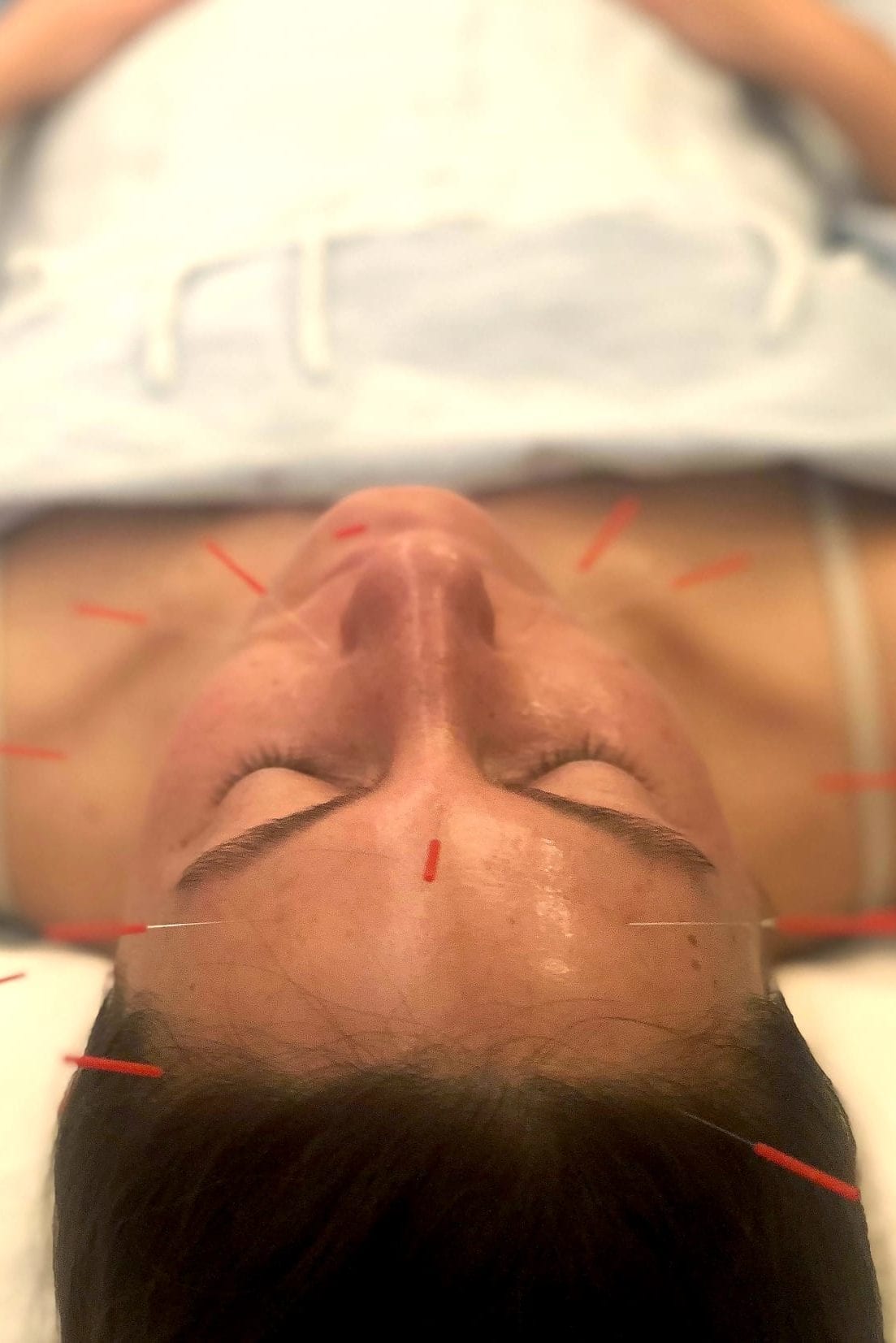 A woman gets an acupuncture facial.