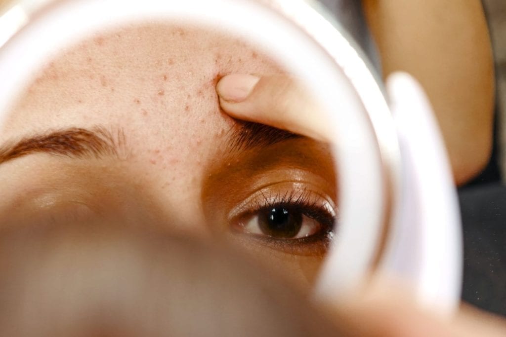 A woman looking in the mirror at her forehead covered in acne.