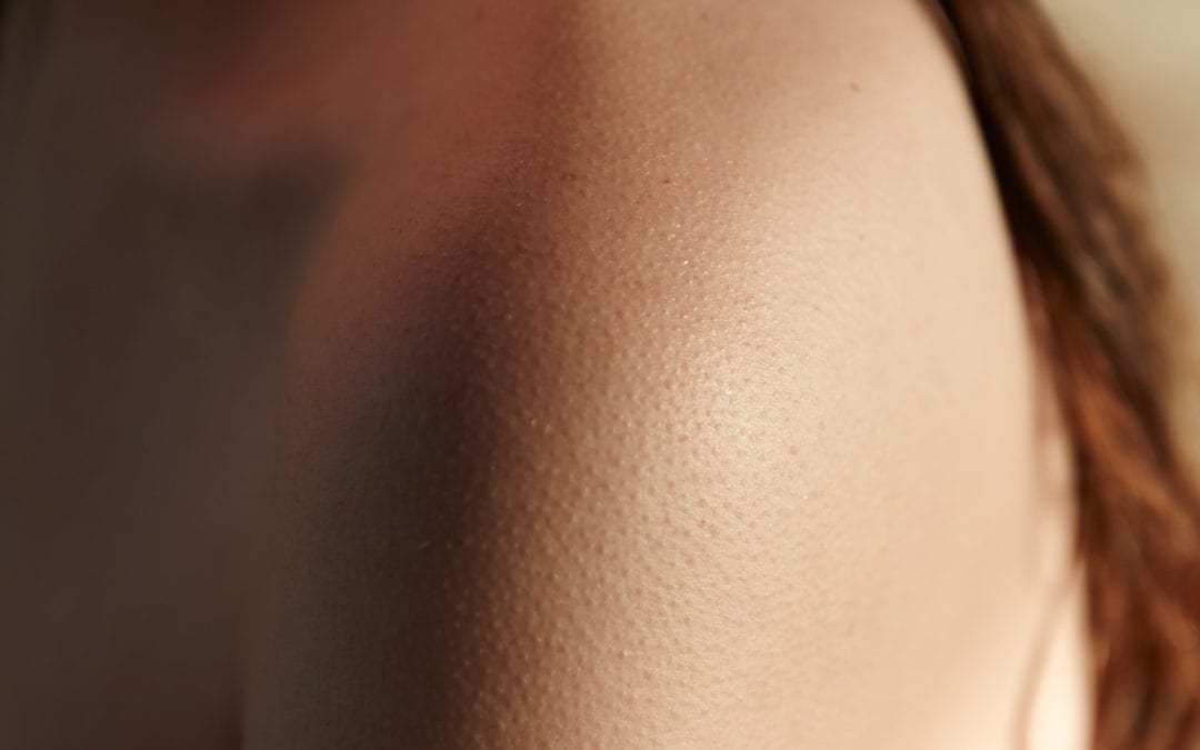 A close up of a woman's should with bumps on her skin.