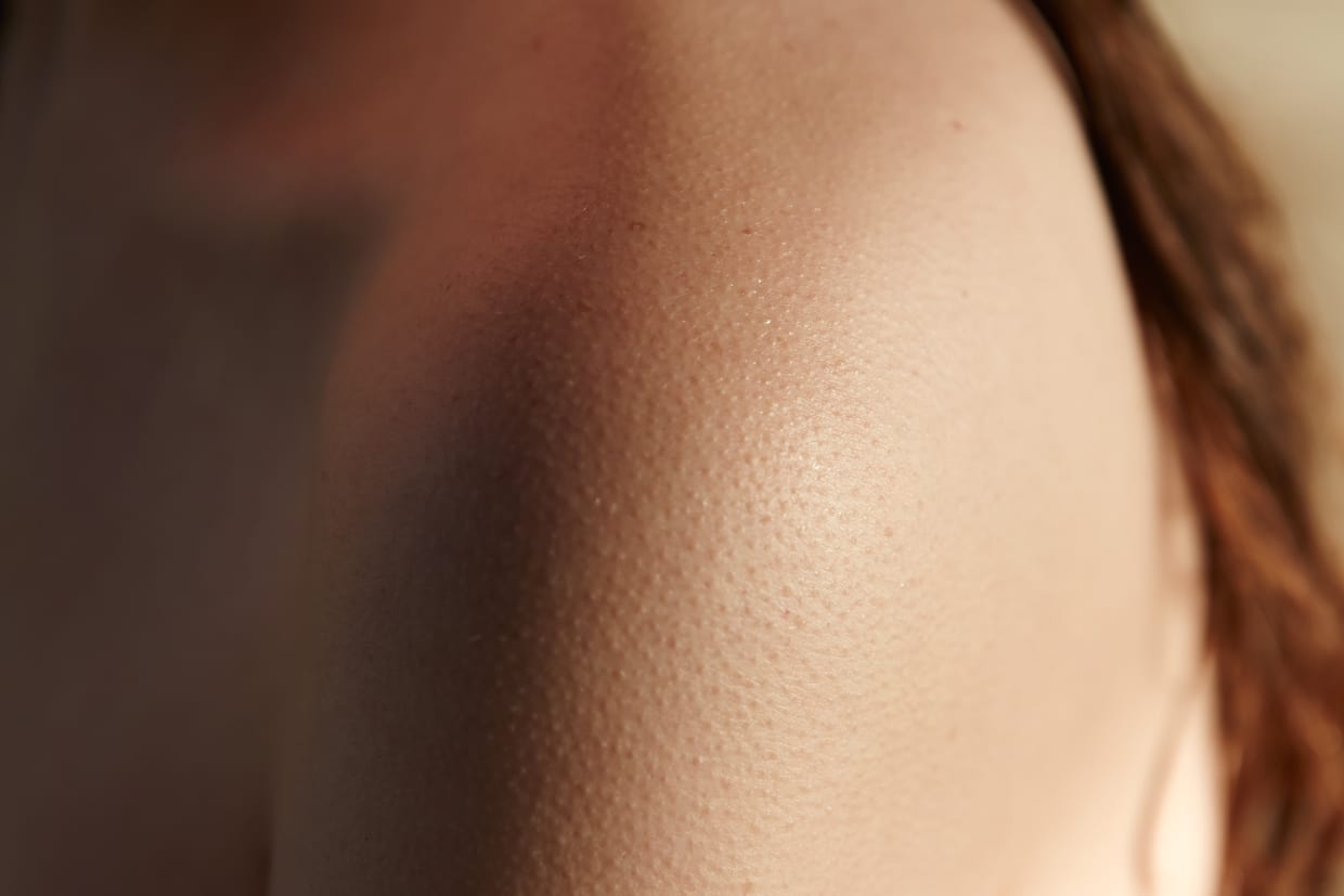 Close up of keratosis pilaris or KP skin bumps