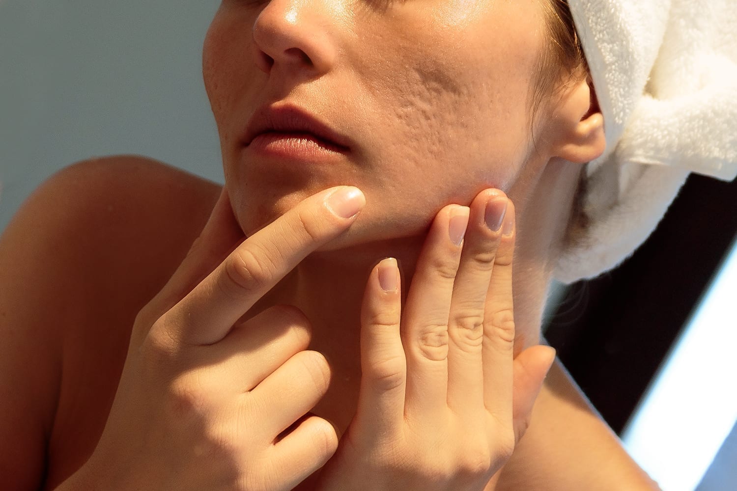 A woman with acne scars looks at her skin in the mirror.