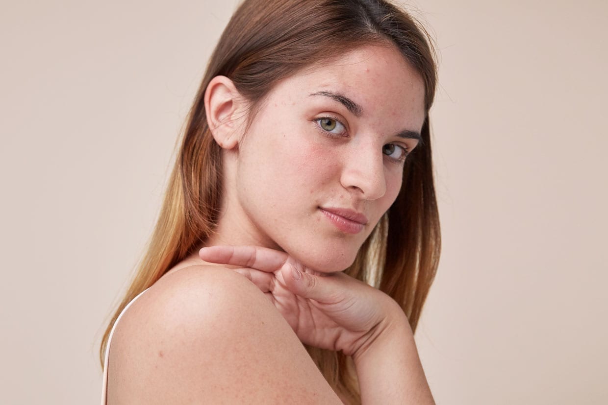 A portrait of a young woman with acne.