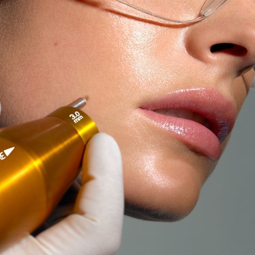 A woman undergoing a laser treatment.