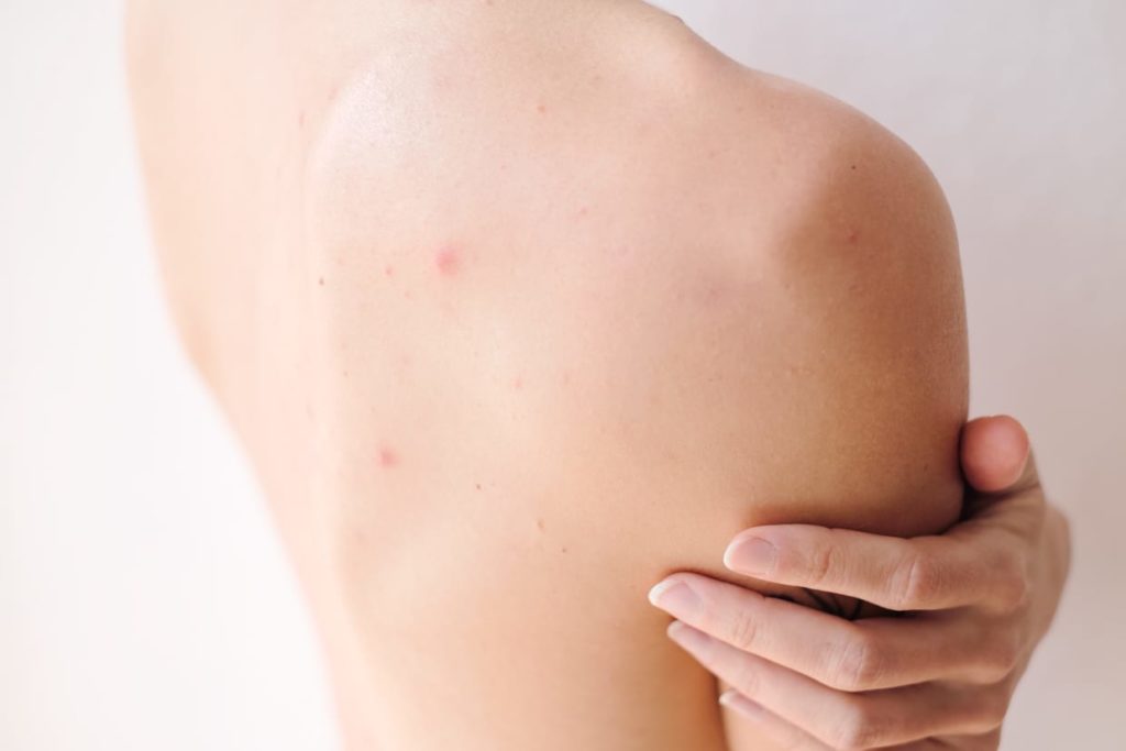 Closeup shot of a woman's back acne.