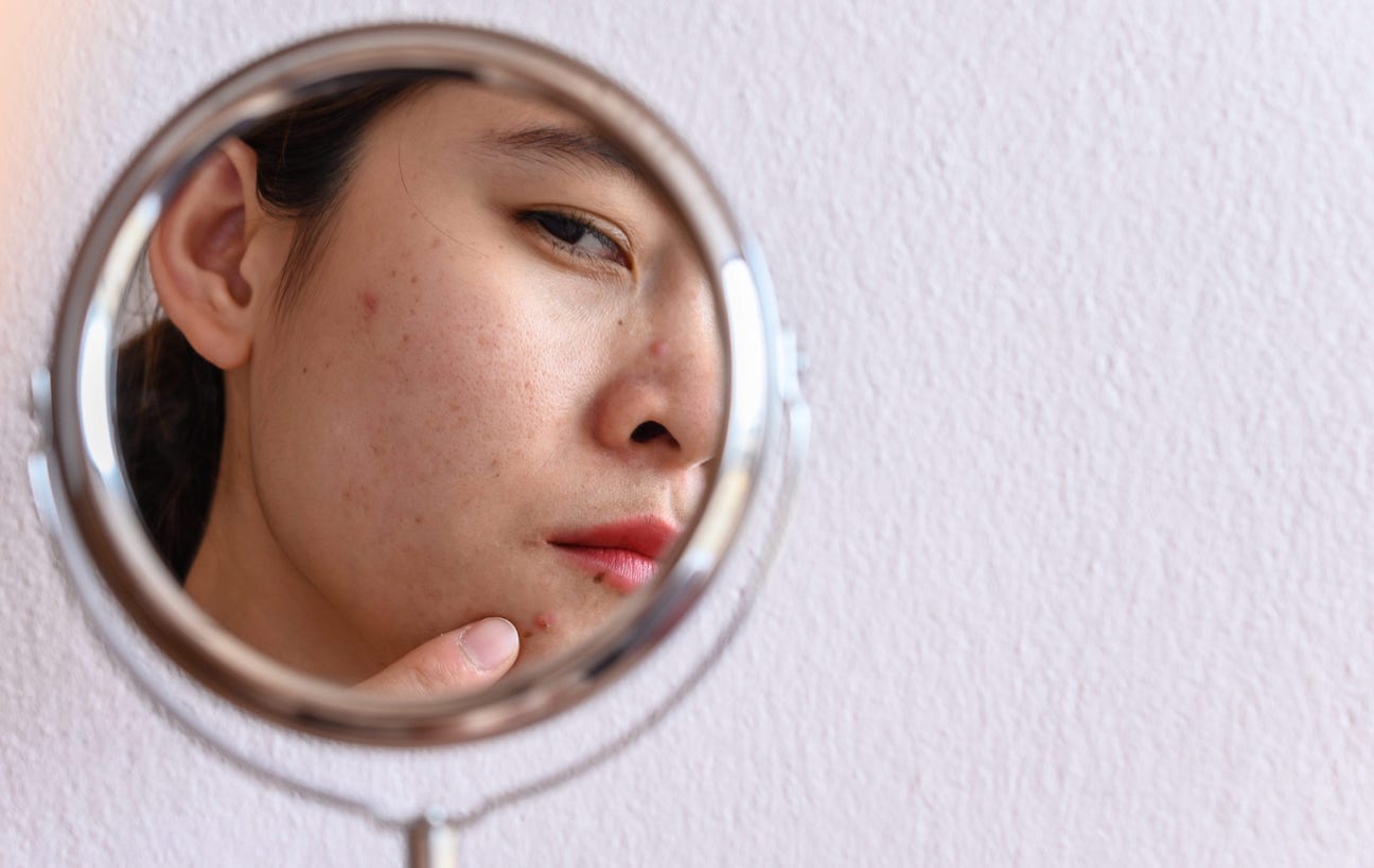 How to Treat Acne Scars