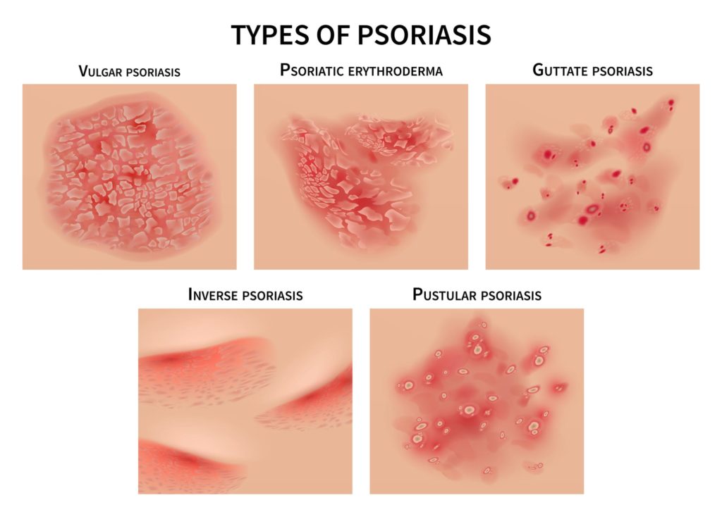Psoriasis types. Skin hives, derma diseases. Closeup medical vector illustration. Dermatology allergy, medical itch and rash, symptom of epidermis
