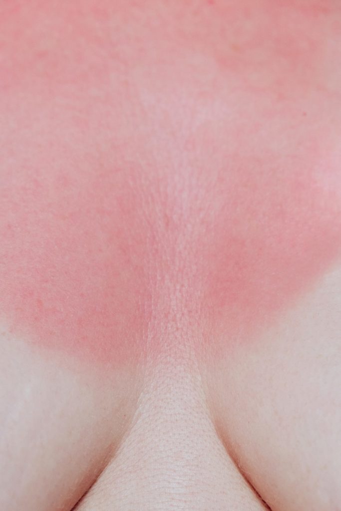 Close Up Of A Woman Sunburn Neckline