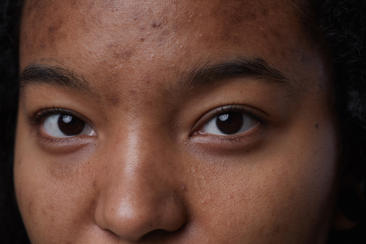 closeup of woman with acne