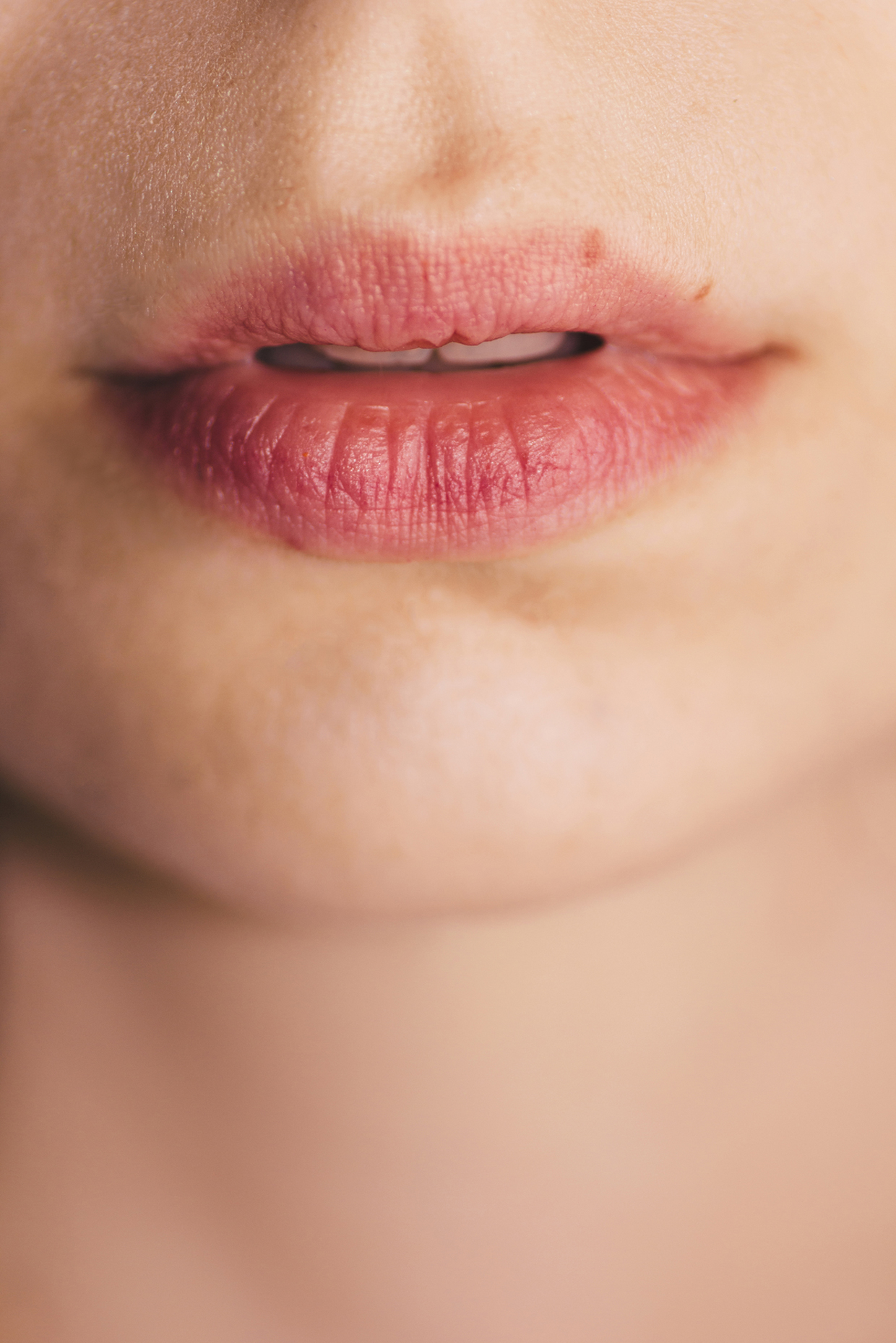 woman chapped lips