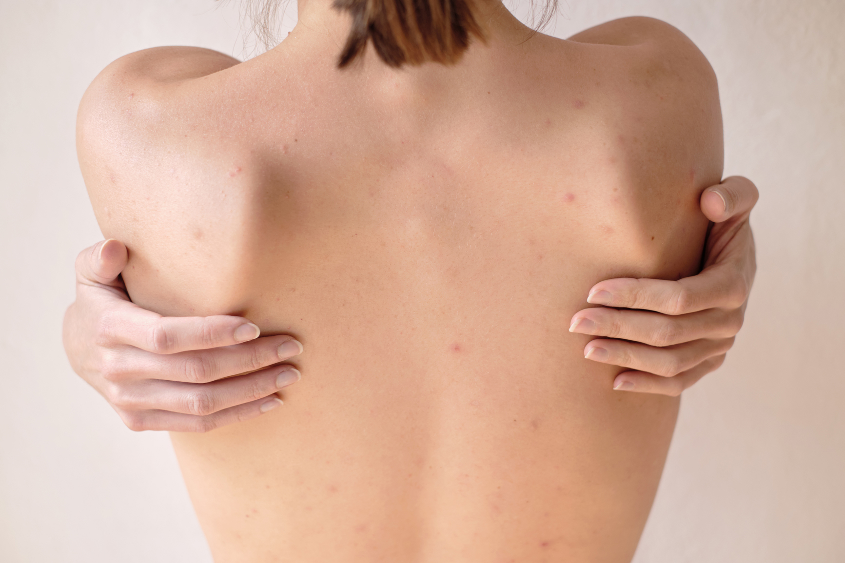 woman with body acne hugging herself