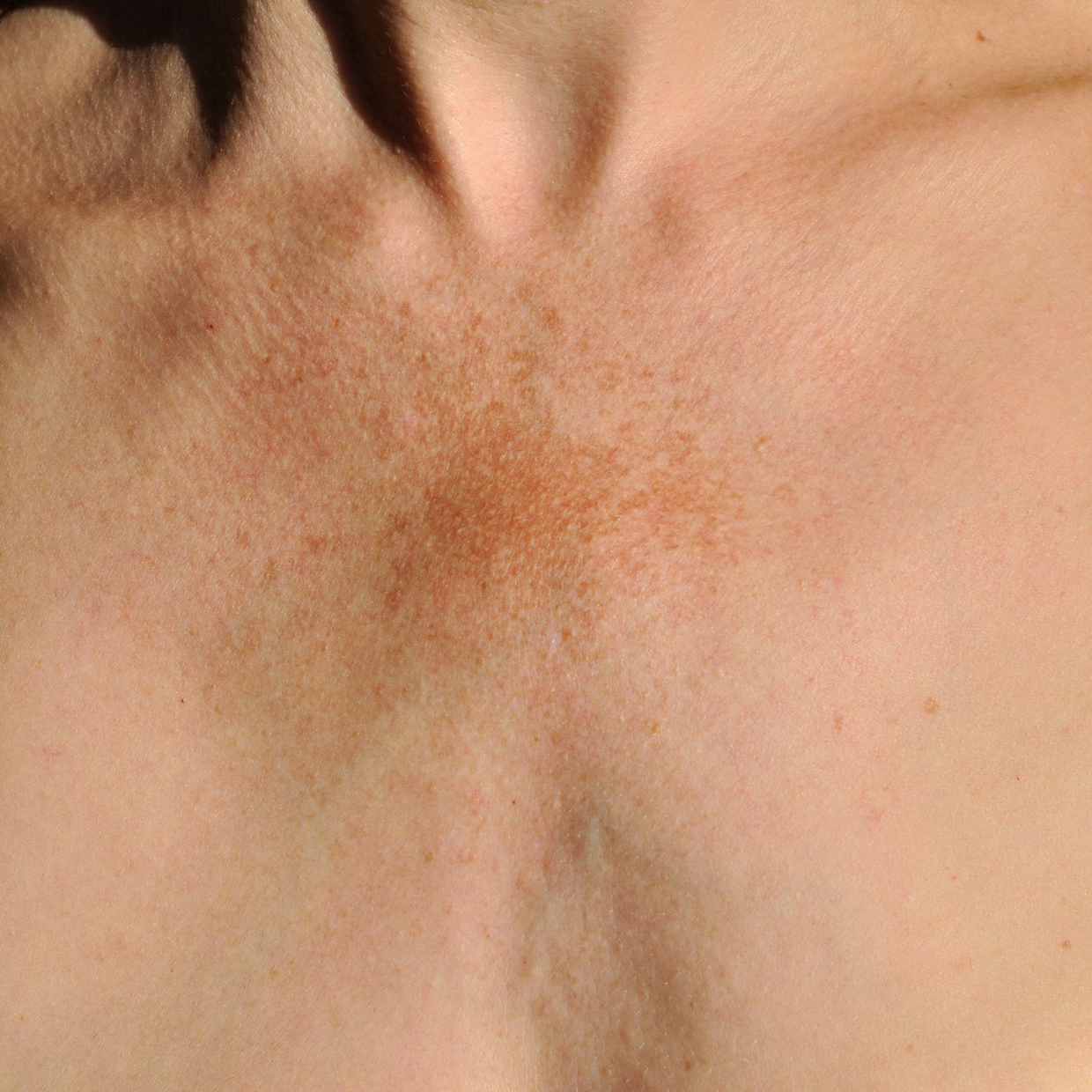 skim pigmentation disorder