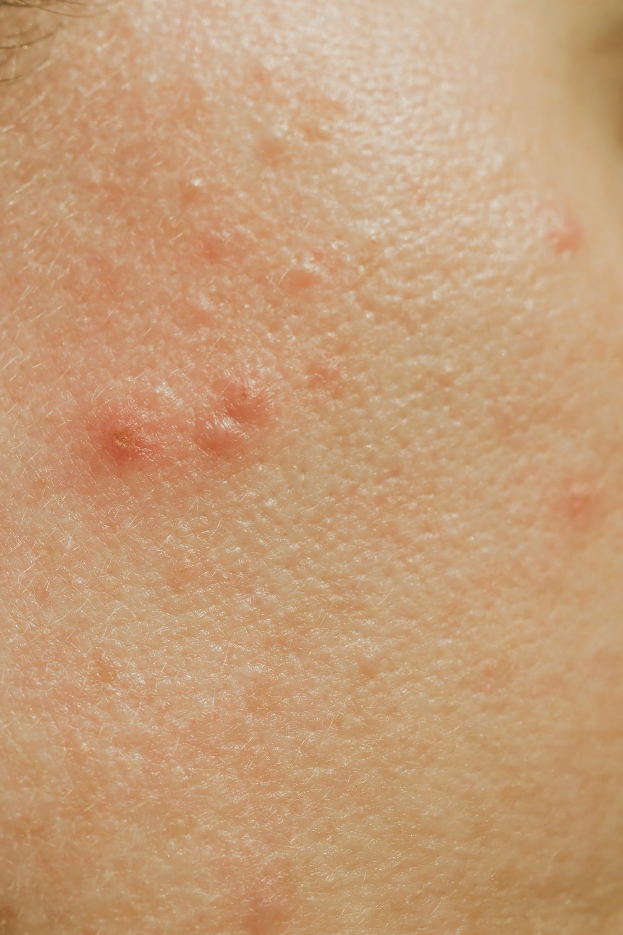 close up of acne