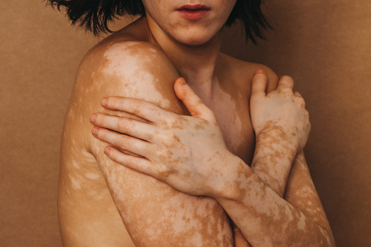 woman with vitiligo in studio