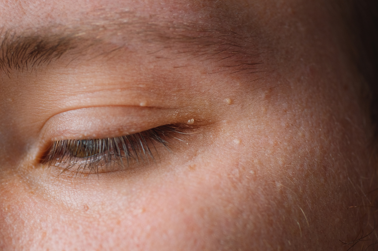 close up of pimples around eye on skin