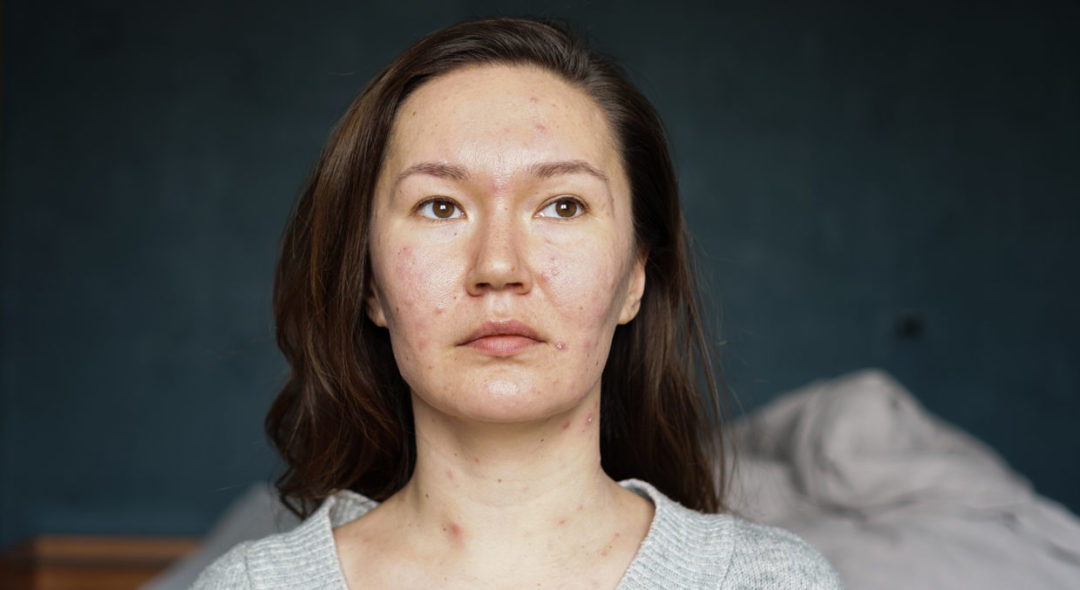 Woman portrait with acne pimples