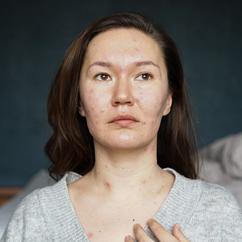 Woman portrait with acne pimples