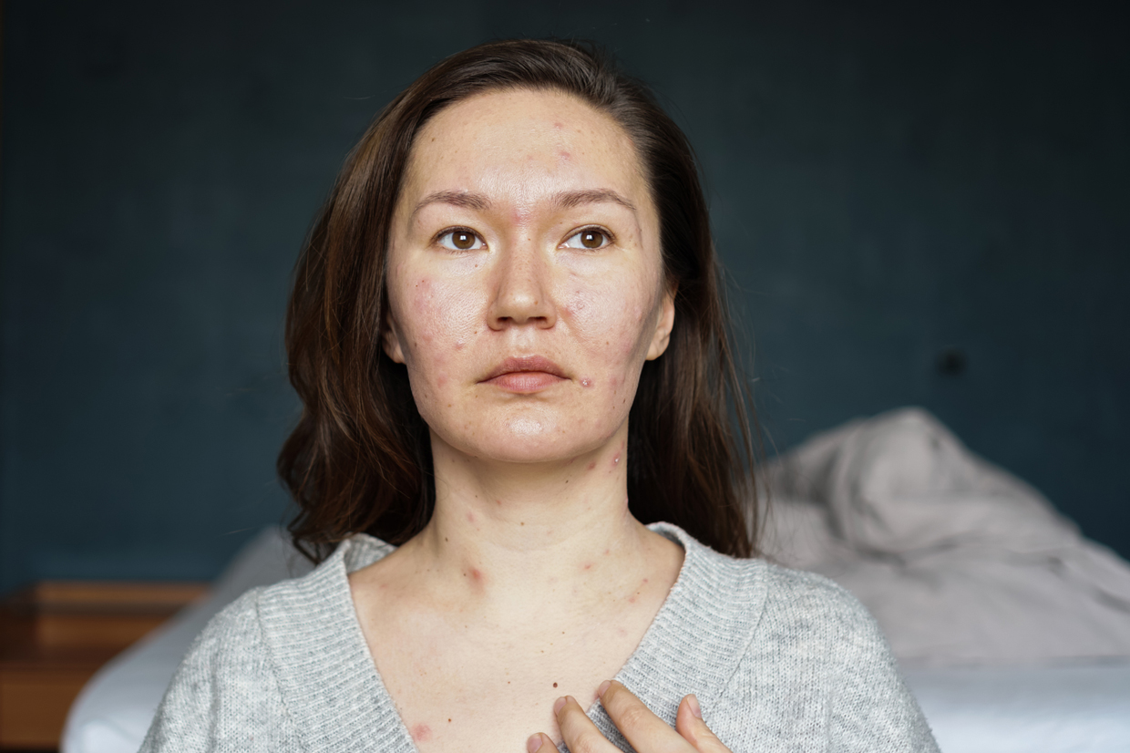 Woman portrait with acne pimples