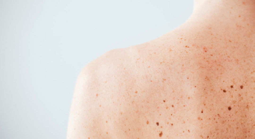 Closeup view shot of skin with birthmarks