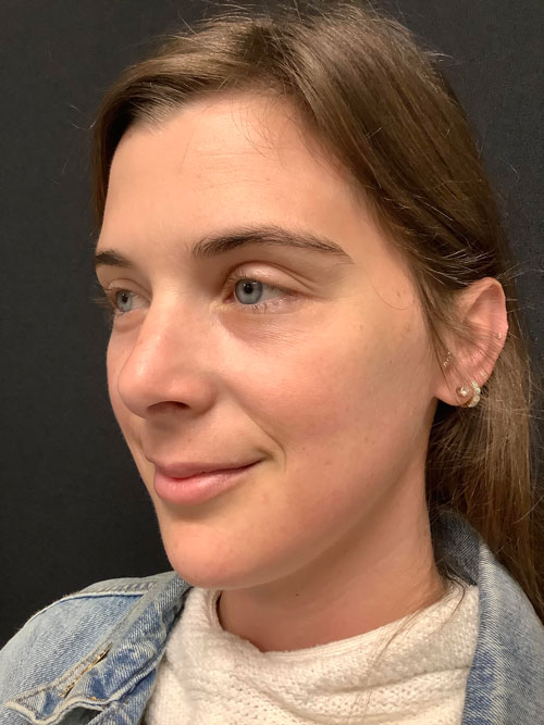 portrait of Jessie Quinn before IPL treatment