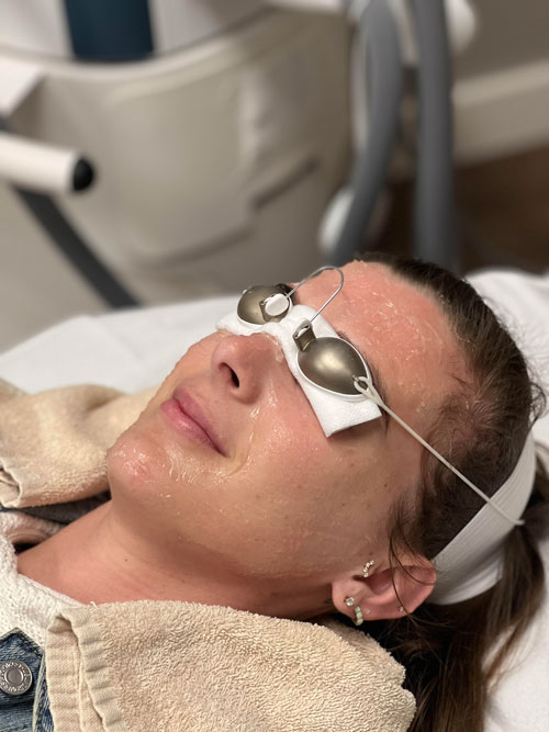 portrait of Jessie Quinn getting IPL treatment