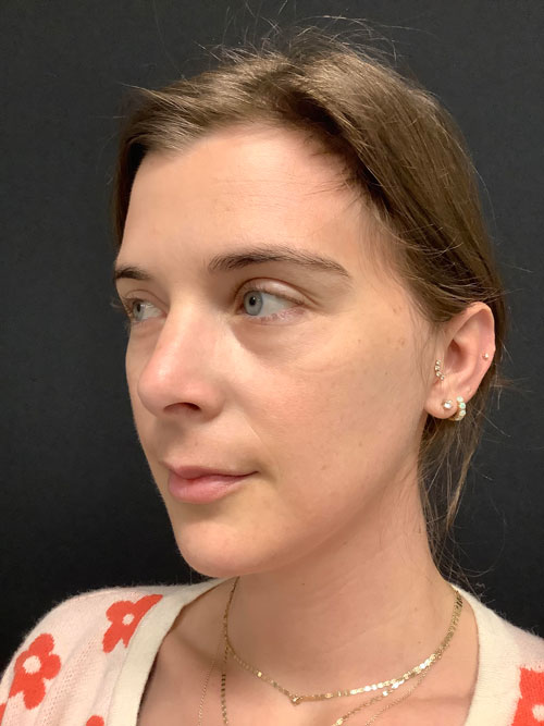 portrait of Jessie Quinn after IPL treatment
