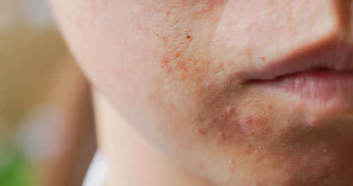 close up of woman with acne problem on her face