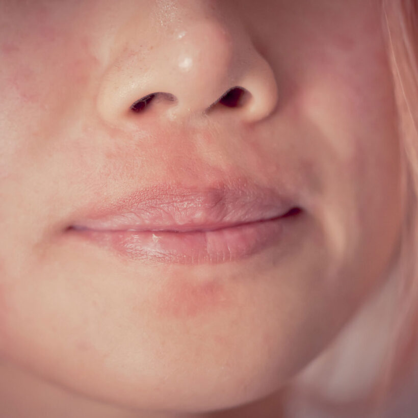 close up of woman's face with allergic reaction