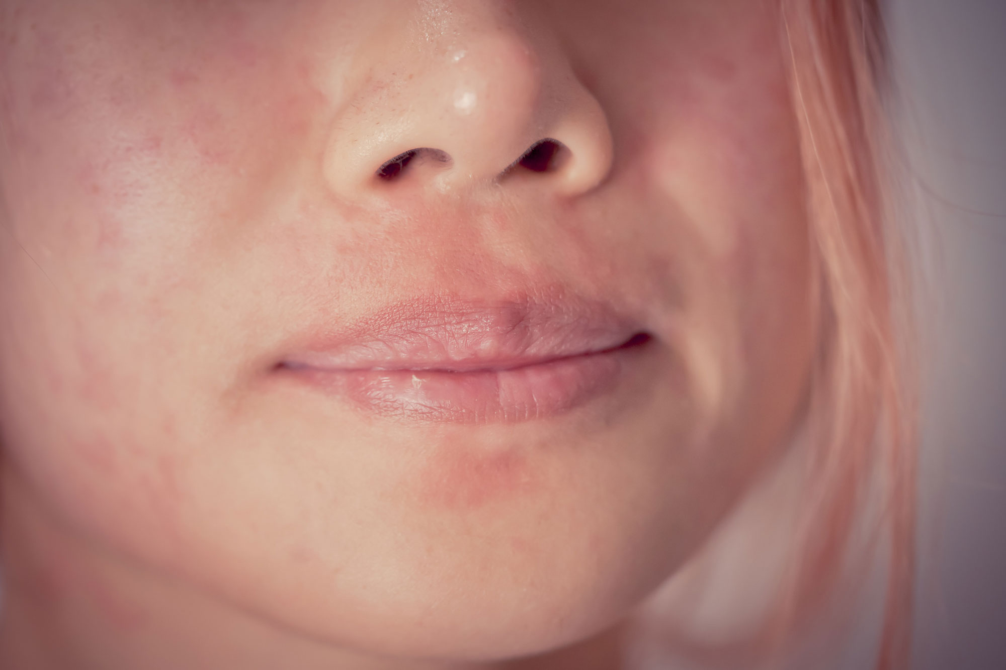 close up of woman's face with allergic reaction