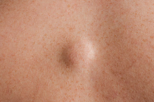 Five types of spot you should never squeeze or pick - and the two