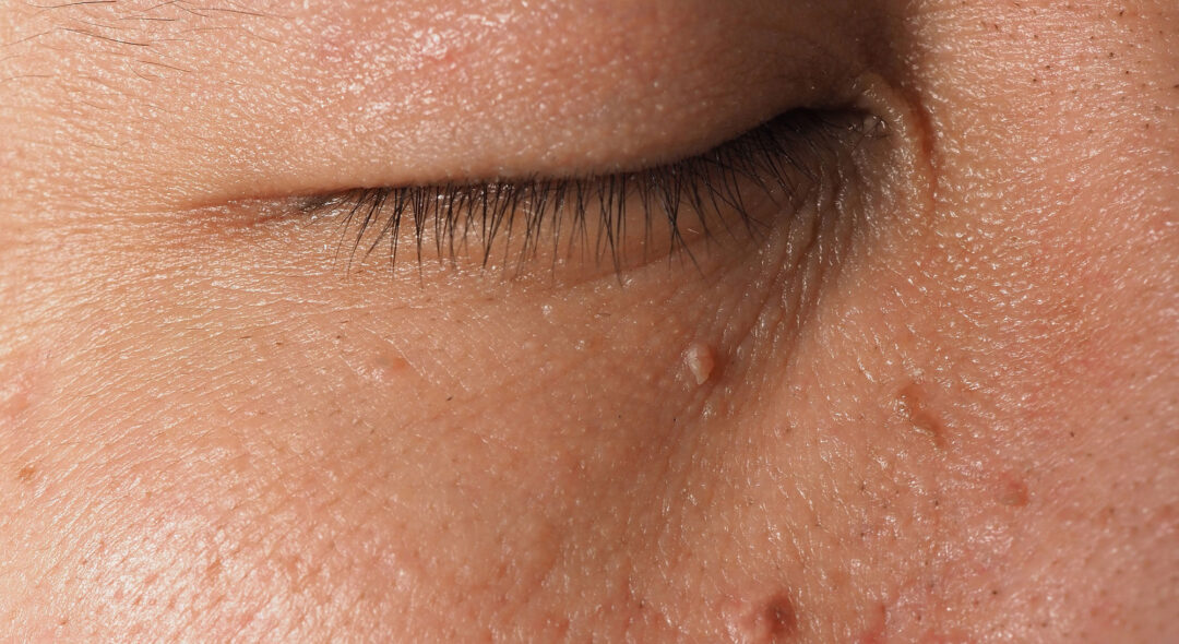Macro shot of warts near eye on face