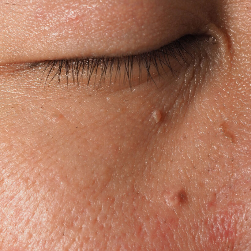 Macro shot of warts near eye on face