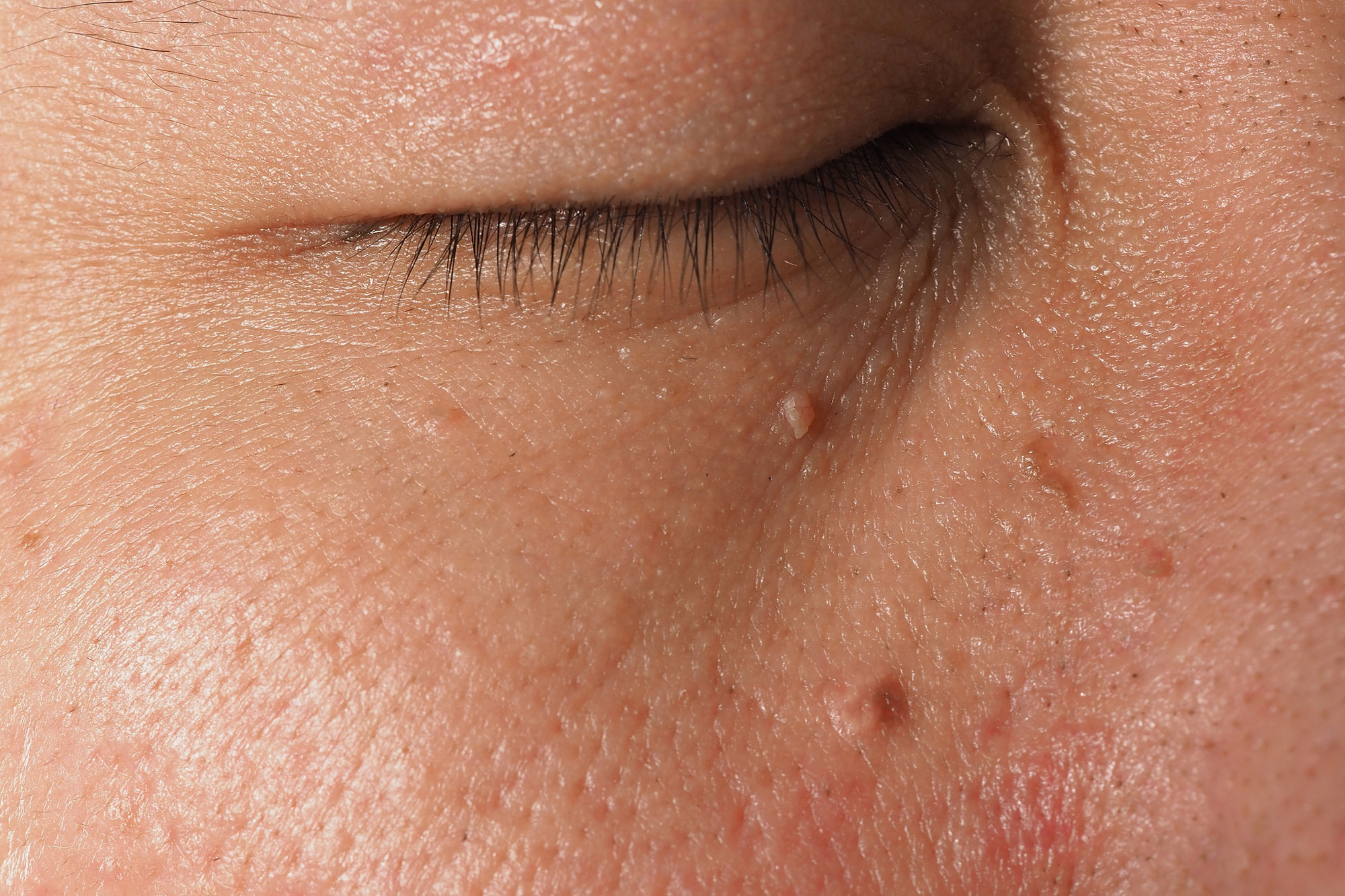 Macro shot of warts near eye on face