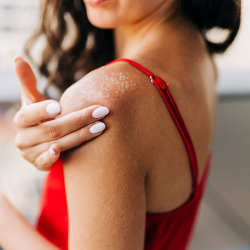 Close up of woman applying moisturizer on sunburned skin