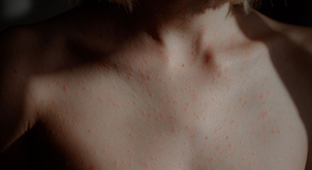 Allergic Reaction On Skin Of Body Close-up