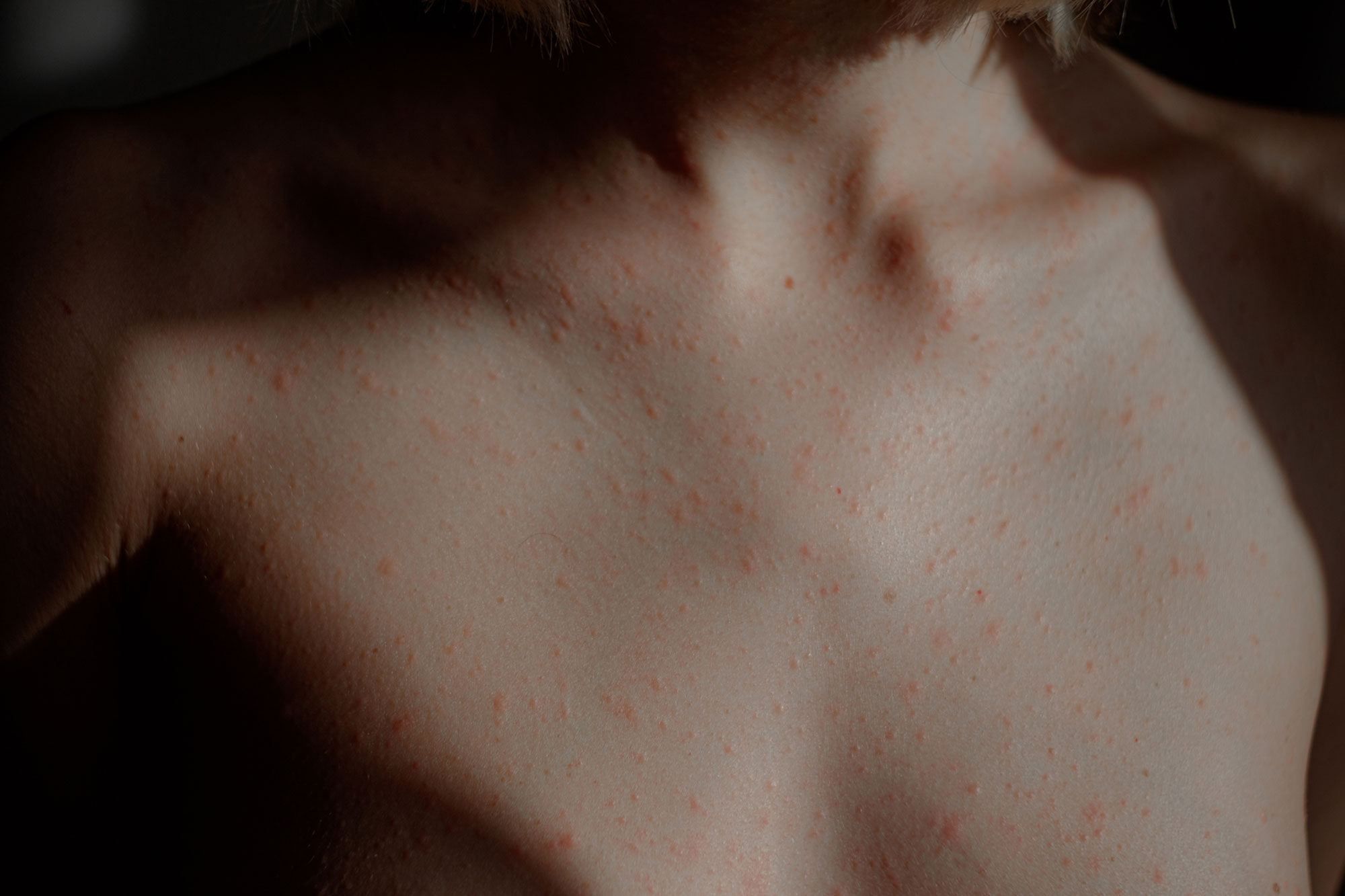Allergic Reaction On Skin Of Body Close-up