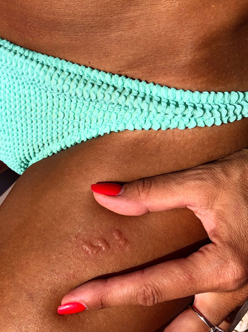 close up of rash on woman's leg