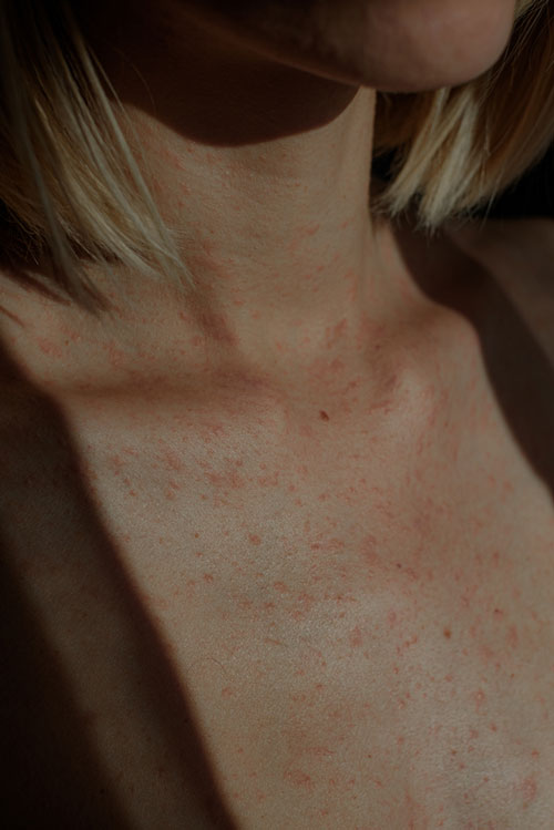mild heat rash on neck