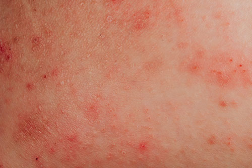 atopic eczema allergy texture
