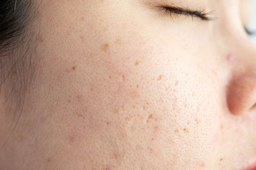 close up of woman's acne scars on face