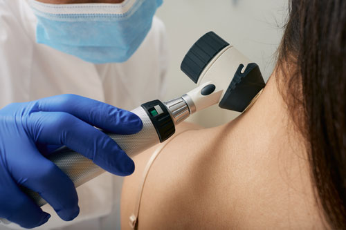 . Doctor examines the patient's mole with a dermatoscope for prevention of melanoma