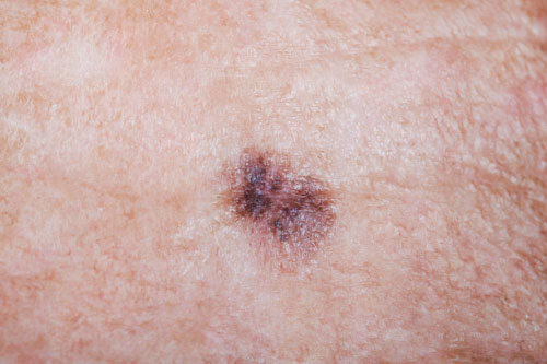 close up of melanoma
