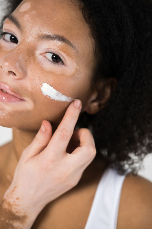 Close up view of the curly woman with vitiligo skin applying moisturizer on her face